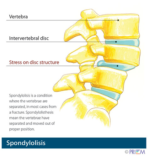 spondylolisis