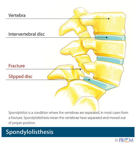 spondylolisthesis