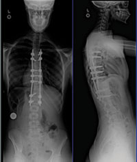 after mini scoliosis surgery xrays